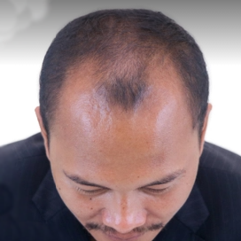 Hair Restoration Before & After Patient #124