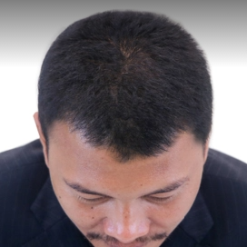 Hair Restoration Before & After Patient #124