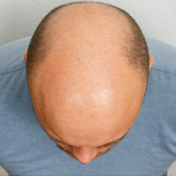 Hair Restoration Before & After Patient #189