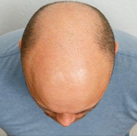 Hair Restoration Before & After Patient #189