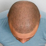 Hair Restoration Before & After Patient #189