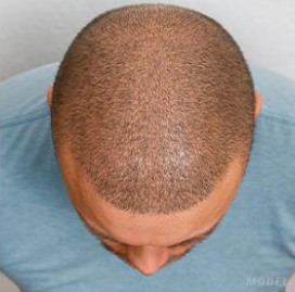 Hair Restoration Before & After Patient #189