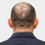 Hair Restoration Before & After Patient #190