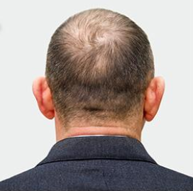 Hair Restoration Before & After Patient #190