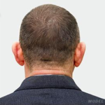 Hair Restoration Before & After Patient #190