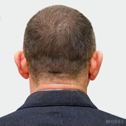Hair Restoration Before & After Patient #190
