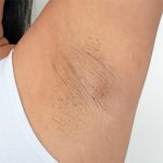 Armpit Before & After Patient #221