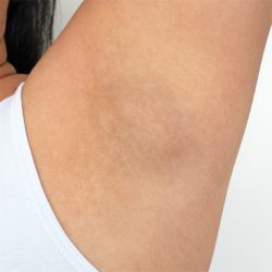Armpit Before & After Patient #221