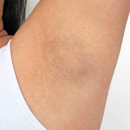 Armpit Before & After Patient #221