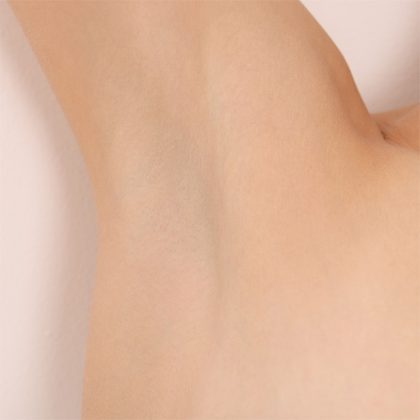 Armpit Before & After Patient #224