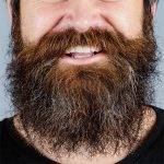 Facial Hair Transplant Before & After Patient #211