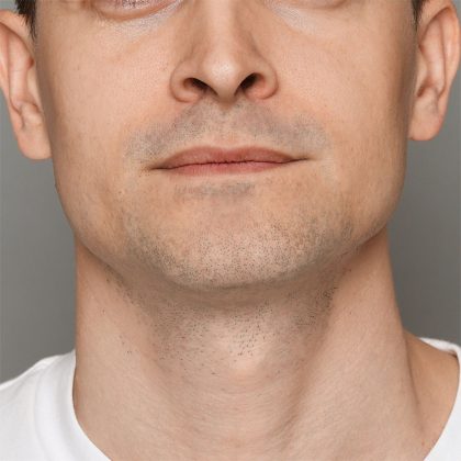 Facial Hair Transplant Before & After Patient #212
