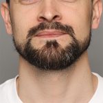 Facial Hair Transplant Before & After Patient #212