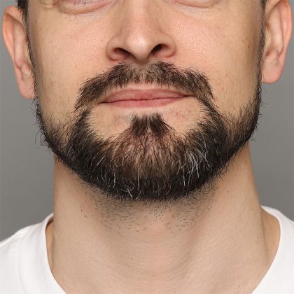 Facial Hair Transplant Before & After Patient #212