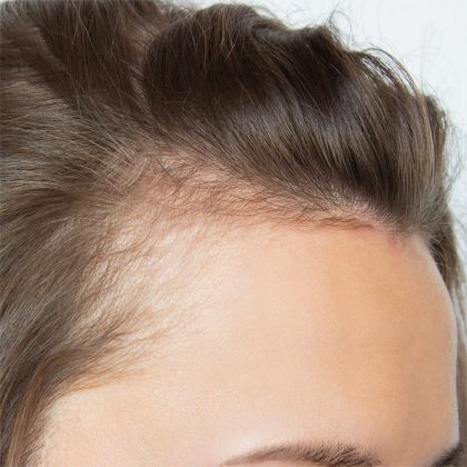 Hair Restoration Before & After Patient #215