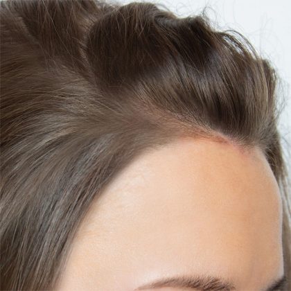 Hair Restoration Before & After Patient #215