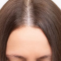 Hair Restoration Before & After Patient #218
