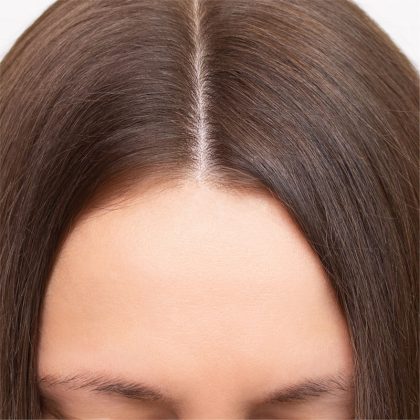 Hair Restoration Before & After Patient #218