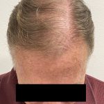 Hair Restoration Before & After Patient #242