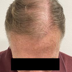 Hair Restoration Before & After Patient #242