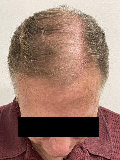 Hair Restoration Before & After Patient #242