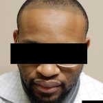 Hair Restoration Before & After Patient #241