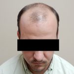 Hair Restoration Before & After Patient #243