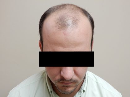 Hair Restoration Before & After Patient #243