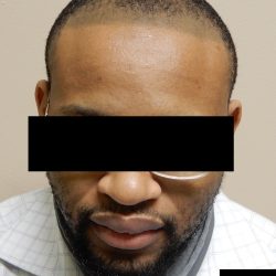 Hair Restoration Before & After Patient #241