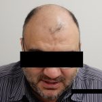Hair Restoration Before & After Patient #244