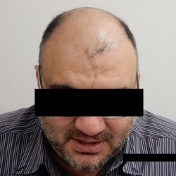 Hair Restoration Before & After Patient #244