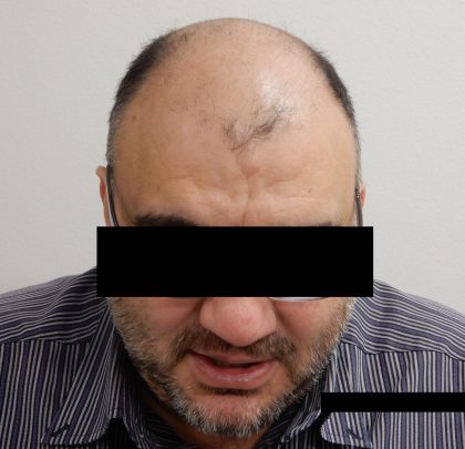 Hair Restoration Before & After Patient #244