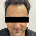 Hair Restoration Before & After Patient #245