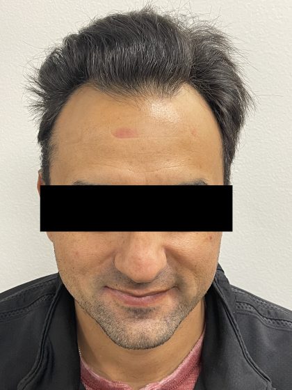 Hair Restoration Before & After Patient #245