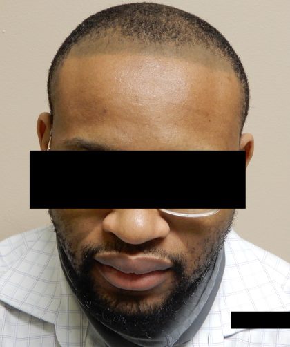 Hair Restoration Before & After Patient #241