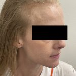 Hair Restoration Before & After Patient #246