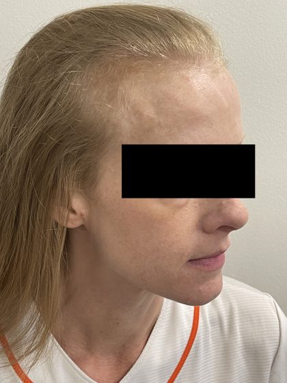 Hair Restoration Before & After Patient #246
