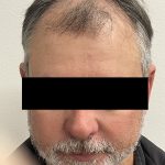 Hair Restoration Before & After Patient #247