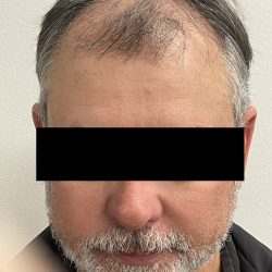 Hair Restoration Before & After Patient #247