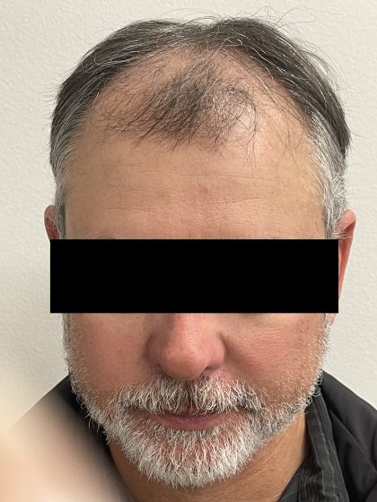 Hair Restoration Before & After Patient #247
