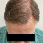 Hair Restoration Before & After Patient #242