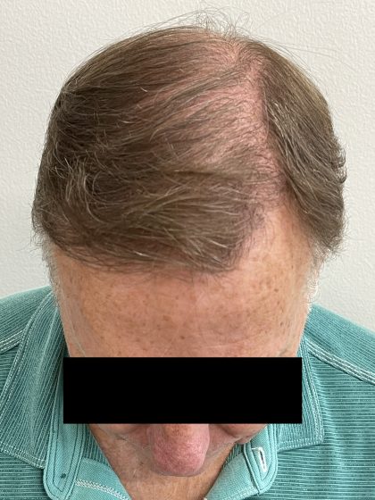 Hair Restoration Before & After Patient #242