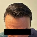 Hair Restoration Before & After Patient #245