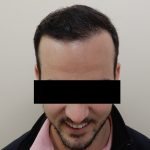 Hair Restoration Before & After Patient #243