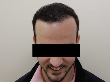 Hair Restoration Before & After Patient #243
