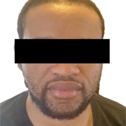 Hair Restoration Before & After Patient #241