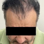 Hair Restoration Before & After Patient #244