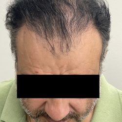 Hair Restoration Before & After Patient #244