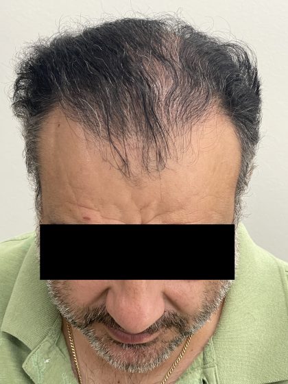 Hair Restoration Before & After Patient #244