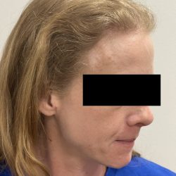Hair Restoration Before & After Patient #246